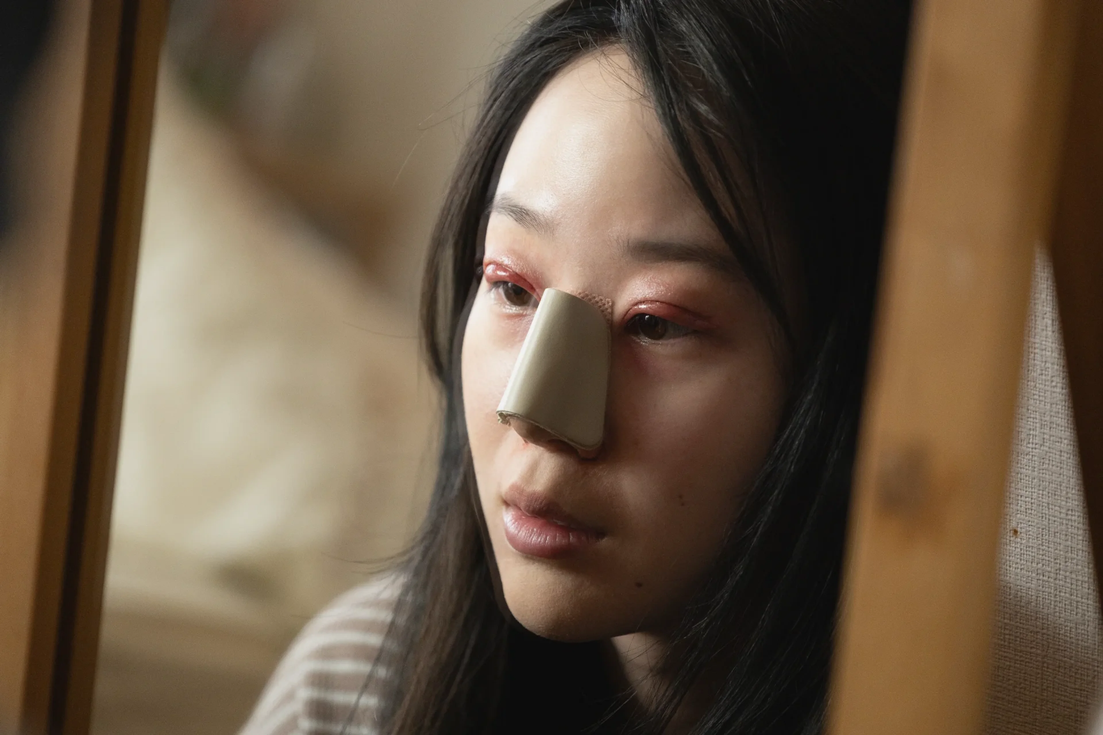A patient has bruised eyelids and a dressing across her nose during recovery.